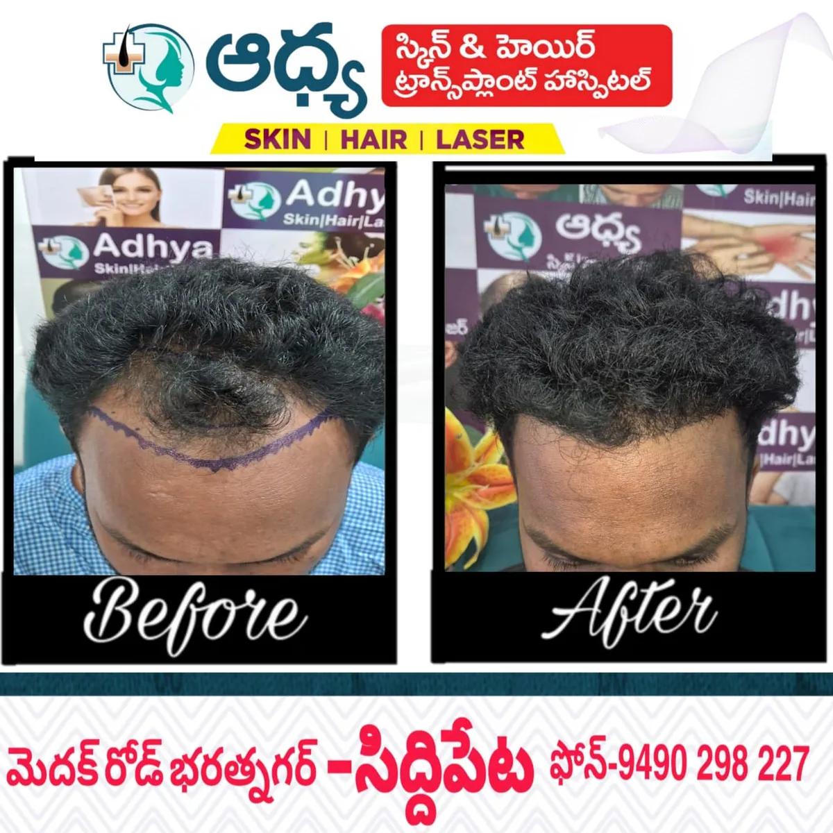 Scalp Density & Hairline Growth Outcome