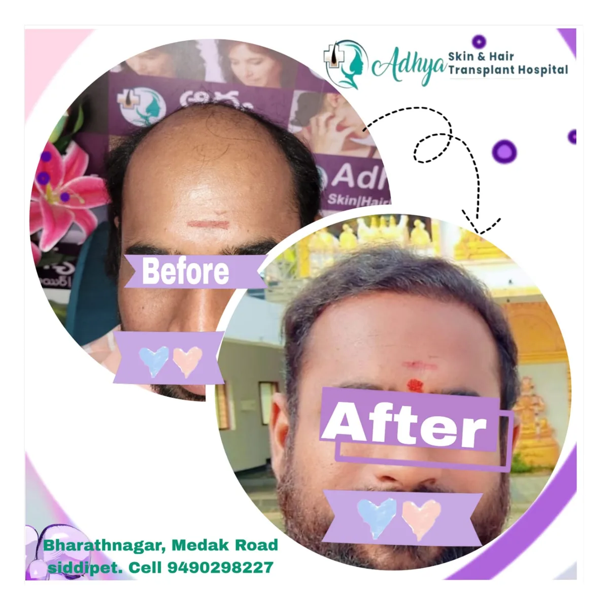 Grade VI Baldness FUE GFC Therapy Result Adhya Hospital