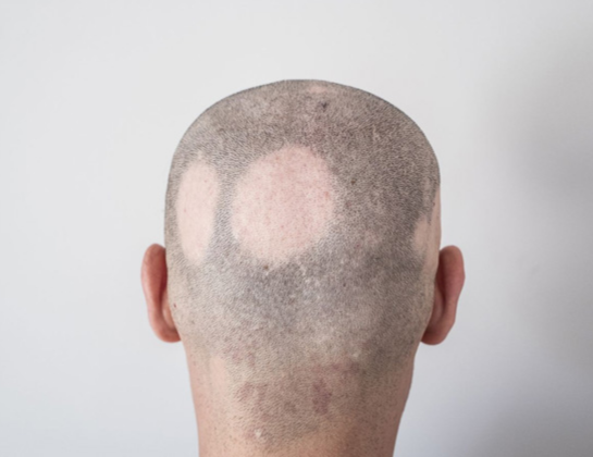 Alopecia Areata treatment near siddipet Best Alopecia Areata treatment near siddipet