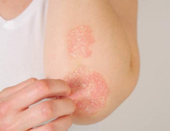 eczema treatment near siddipet Best eczema treatment near siddipet
