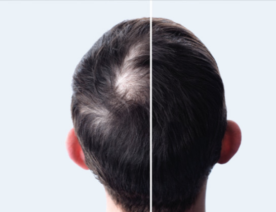 GFC Treatment treatment near siddipet Best GFC Treatment treatment near siddipet