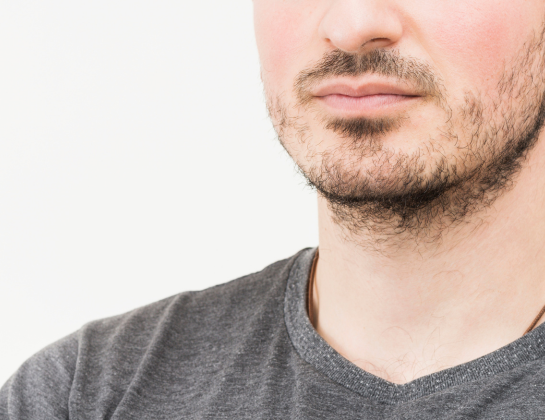 Beard and Moustache Transplants treatment near siddipet Best Beard and Moustache Transplants treatment near siddipet