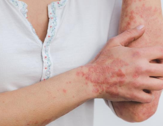 psoriasis treatment near siddipet Best psoriasis treatment near siddipet