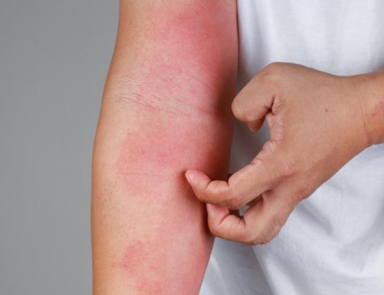 skin allergies treatment near siddipet Best skin allergies treatment near siddipet
