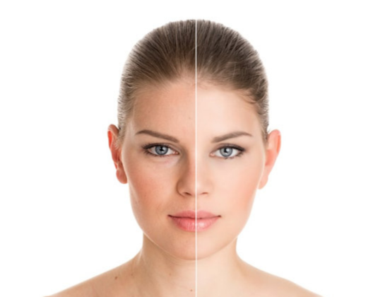 skin rejuvenation treatment near siddipet Best skin rejuvenation treatment near siddipet