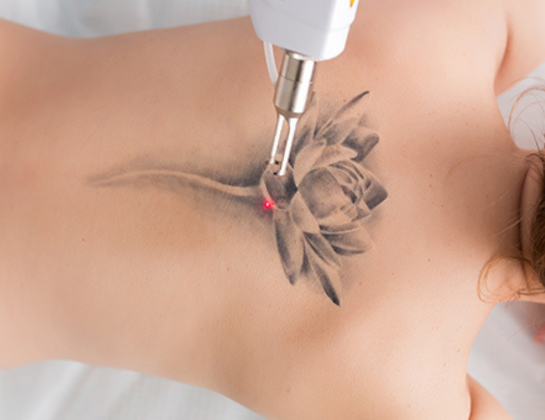 Laser tattoo removal treatment near siddipet Best Laser tattoo removal treatment near siddipet
