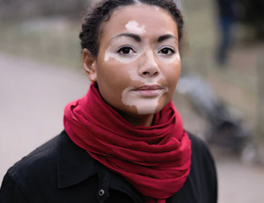 vitiligo treatment near siddipet Best vitiligo treatment near siddipet